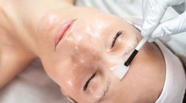 peeling-de-fenol