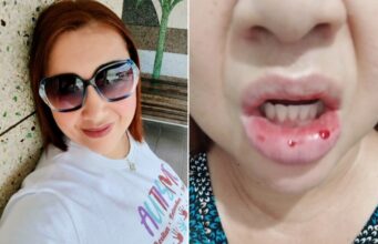 Mulher que ficou com a boca gigante após usar creme dental irá processar Colgate: ‘Fui motivo de chacota’